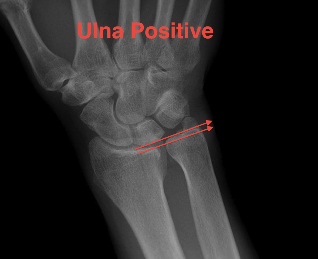 Ulna Variance Positive